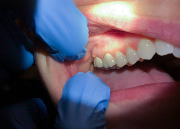 Best Knocked-Out Tooth (Avulsed Tooth) Treatment in Jackson, AL